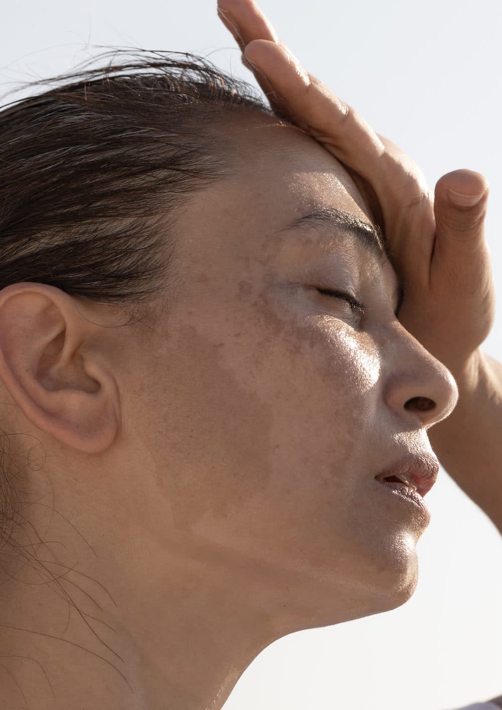 Sun and Hyperpigmentation